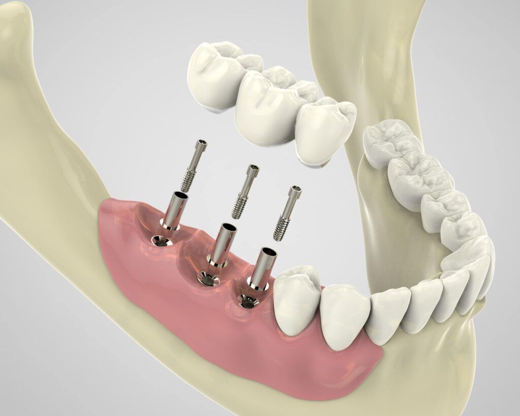 Dental implant procedure showing precision and advanced technology
